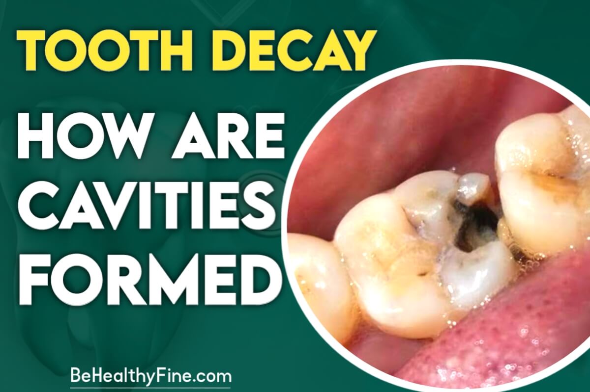 Tooth Decay: How Are Cavities Formed | Visit Site Now